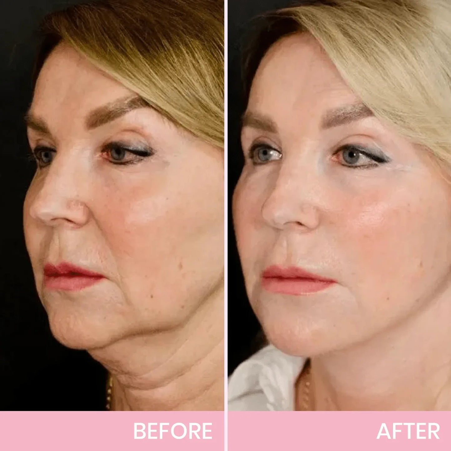 V-Face⭐ Lifting Invisible Adhesive Tape