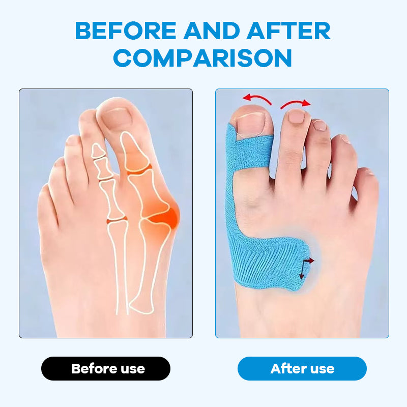 Pre-Cut Bunion Relief Kinesiology Tape 💪Ready-to-Use Corrector Strips
